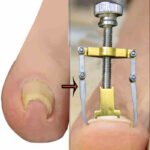 নখের কোনা সোজা করার অত্যাধুনিক যন্ত্র ( Nail Repair